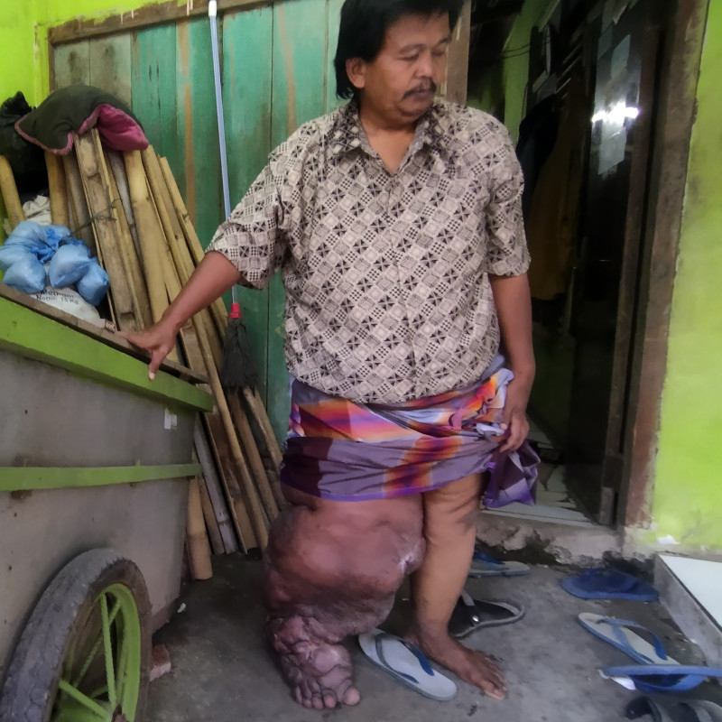 URGENT! PAK NANA HARUS SEGERA OPERASI KAKI GAJAH