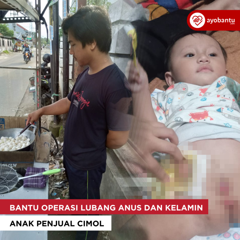 Bantu Operasi Lubang Anus dan Kelamin Anak Penjual Cimol