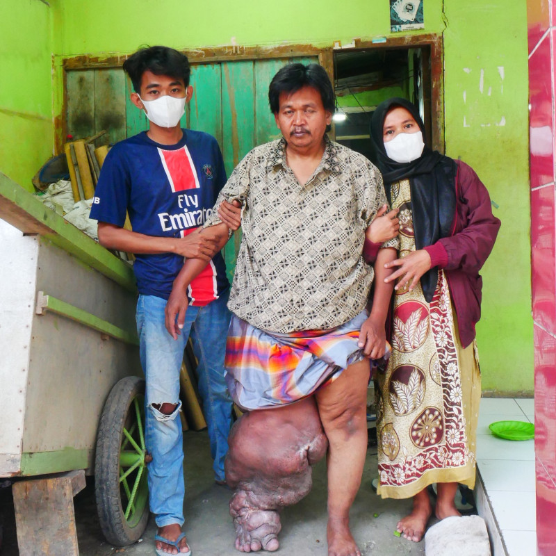 URGENT! PAK NANA HARUS SEGERA OPERASI KAKI GAJAH