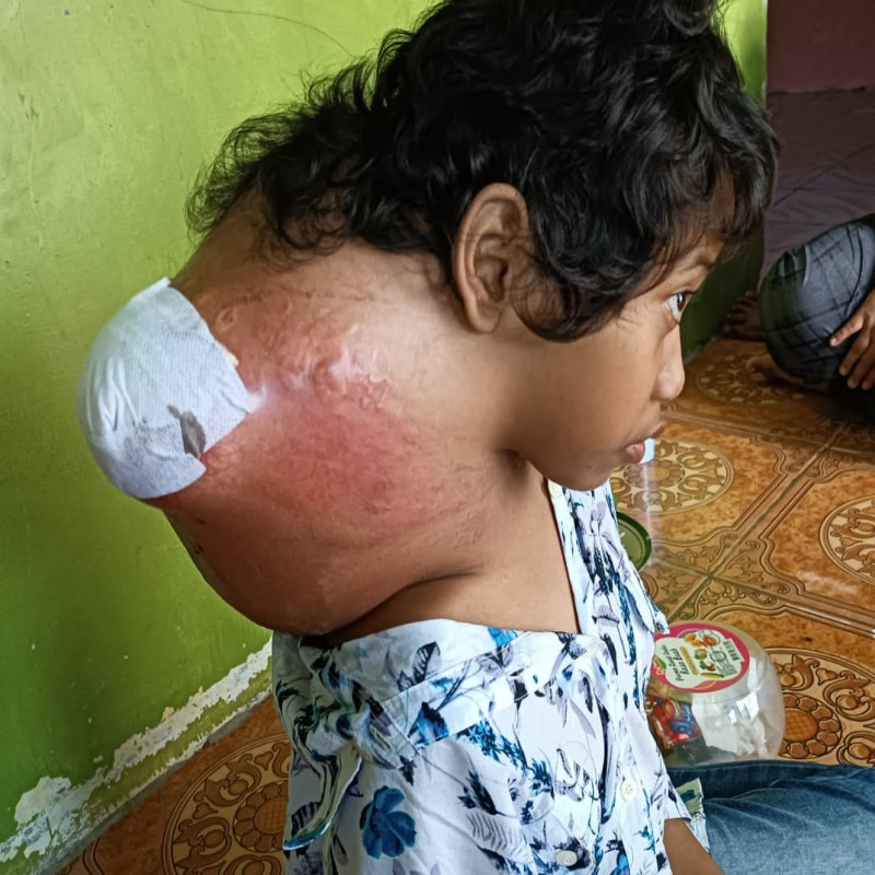 Darurat! Tumor Ganas Semakin Membesar, Aisyah Butuh Operasi Segera.
